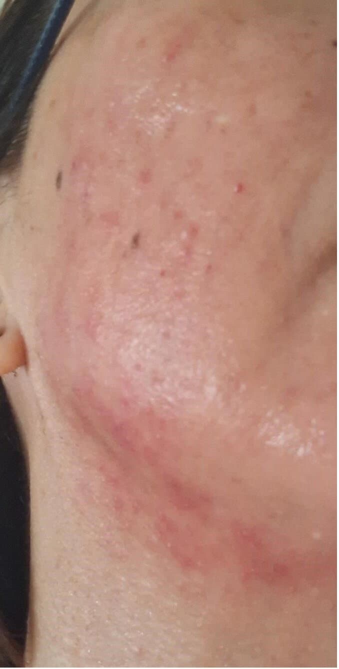 HSA Photo of consumers skin reaction on face and neck